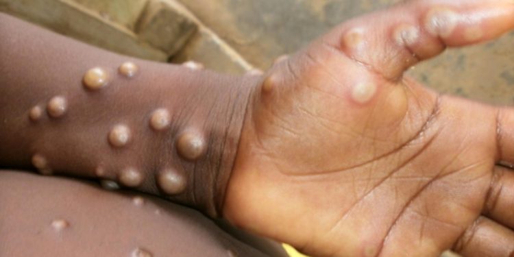 Monkeypox nearing global health emergency status as WHO convenes to consider developments
