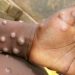 Monkeypox nearing global health emergency status as WHO convenes to consider developments